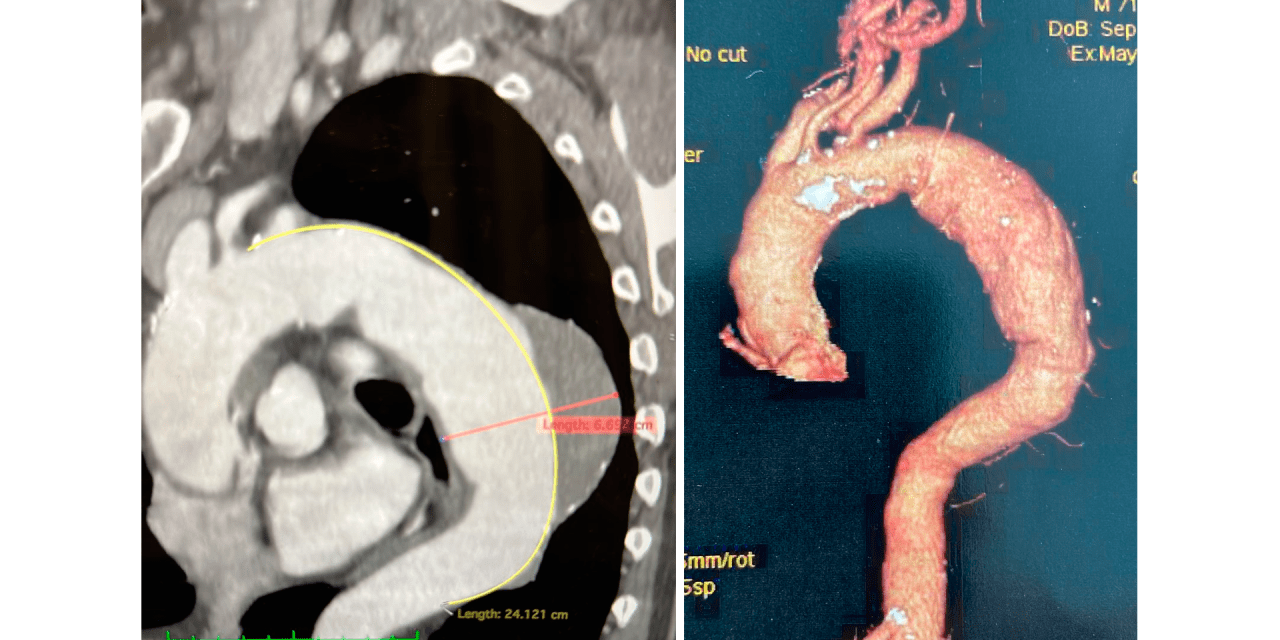 CIRURGIA VASCULAR INÉDITA NA BAHIA É REALIZADA NA SANTA CASA DE ITABUNA